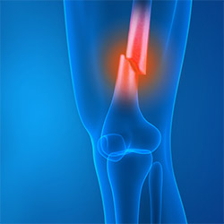 Knee Fracture