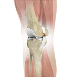 Knee Ligament Injuries