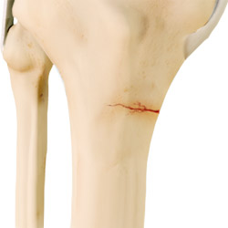 Knee Stress Fractures