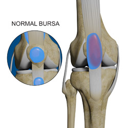 Kneecap Bursitis