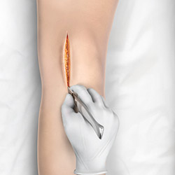Minimally Invasive Knee Joint Replacement