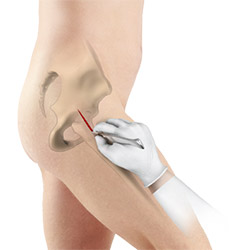 Minimally Invasive Total Hip Replacement
