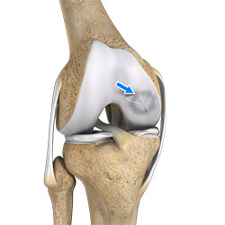 Osteochondritis Dissecans of the Knee