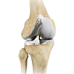 Partial Knee Resurfacing