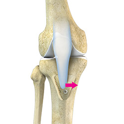 Patellofemoral Realignment