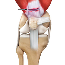 Quadriceps Tendon Rupture