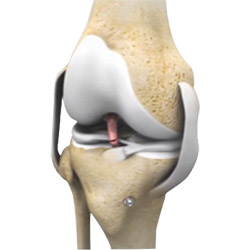 Revision Knee Ligament Reconstruction