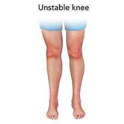 Unstable Knee
