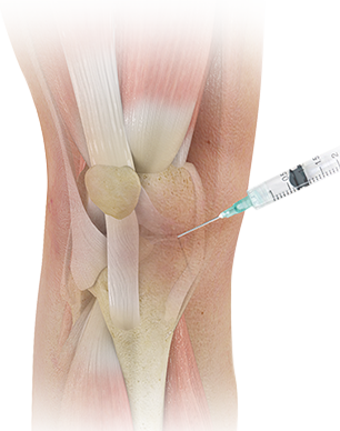 Platelet Rich Plasma Injections