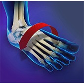 Ankle Instability