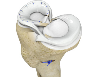 Meniscal Injuries
