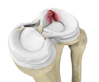 Meniscal Tears