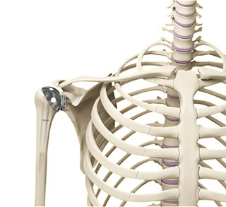 Shoulder Joint Replacement