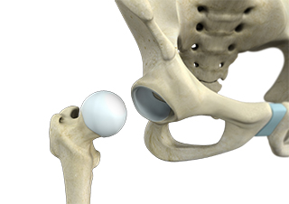 Surgical Dislocation of the Hip