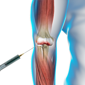 Viscosupplementation for Elbow