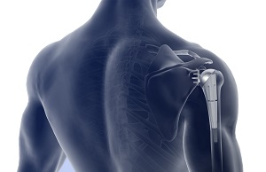 Am I a Candidate for Shoulder Surgery?
