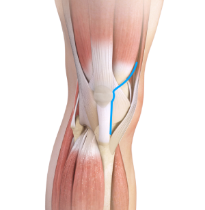 Muscle-sparing Knee Replacement 
