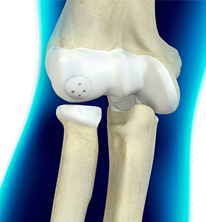 Cartilage Restoration