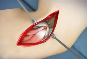 Elbow Surgery