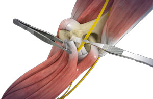 Open Cubital Tunnel Repair