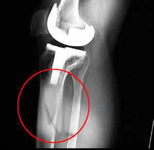 Periprosthetic Knee Fractures
