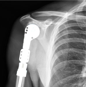 Proximal Humerus Resection and Reconstruction