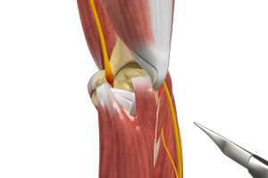 Ulnar Nerve Transposition
