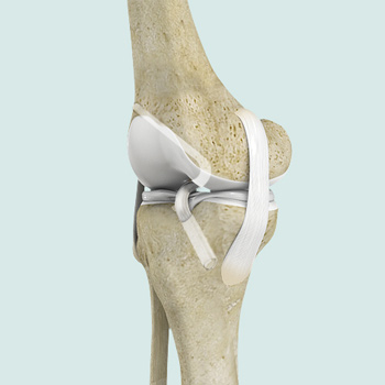 ACL Reconstruction