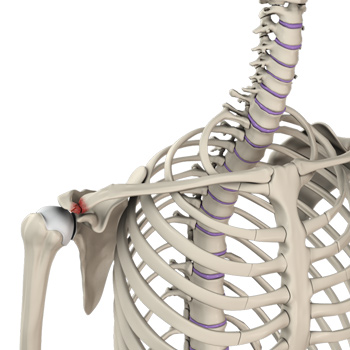 Acromioclavicular (AC) Joint Injuries