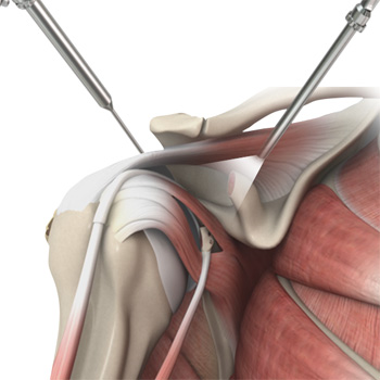 Arthroscopic Latarjet for Shoulder Instability