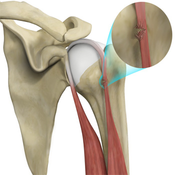 Bisceps Tendon Rupture