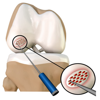 Cartilage Microfracture