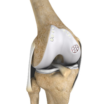 Cartilage Replacement