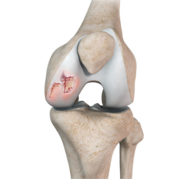 Chondral or Articular Cartilage Defects