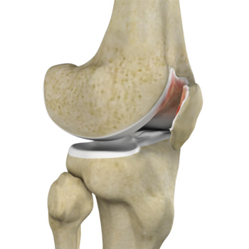 Chondromalacia Patella