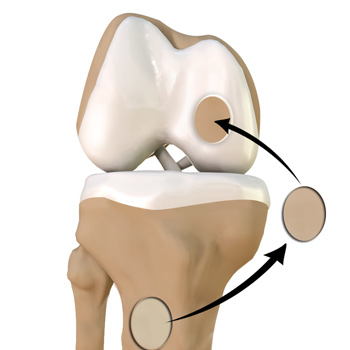 Chondroplasty