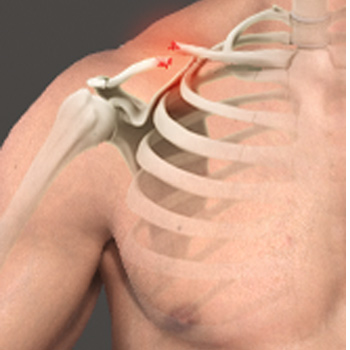 Clavicle Fracture