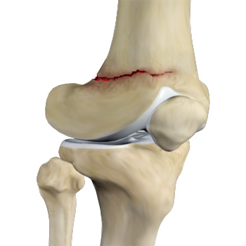 Distal Femur Fracture