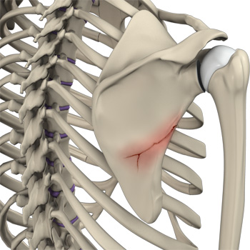 Fracture of the Shoulder Blade