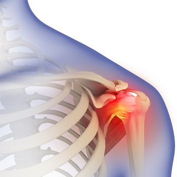 Frozen Shoulder