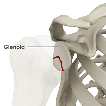 Glenoid Fractures