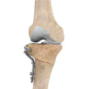 High Tibial Osteotomy