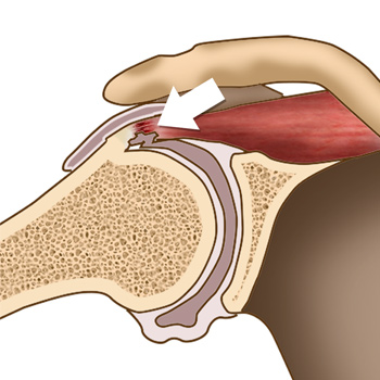 Internal Impingement of the Shoulder