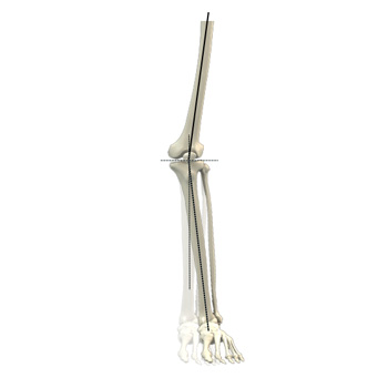 Knee Angular Deformities