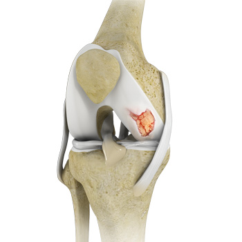 Knee Cartilage Restoration