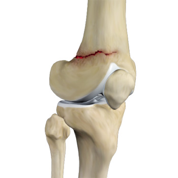 Knee Fracture Surgery