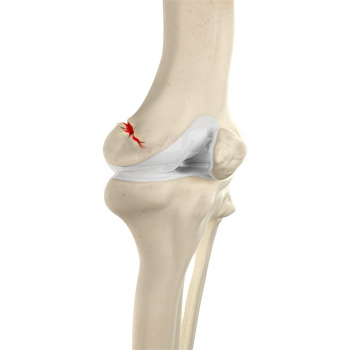 Knee Fracture