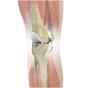 Knee Ligament Injuries