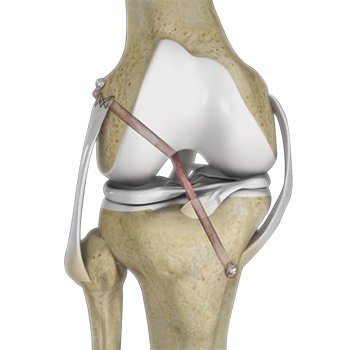 Knee Ligament Reconstruction