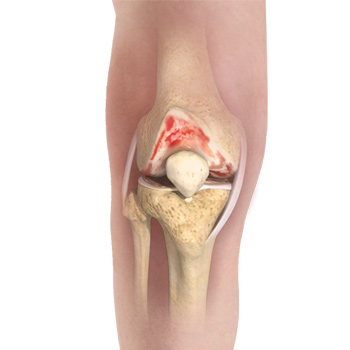 Knee Osteoarthritis